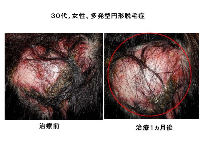 円形脱毛症　病院